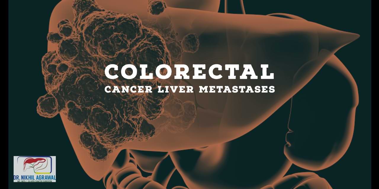 Colorectal Cancer Liver Metastases Treatment And Surgery Dr Nikhil 