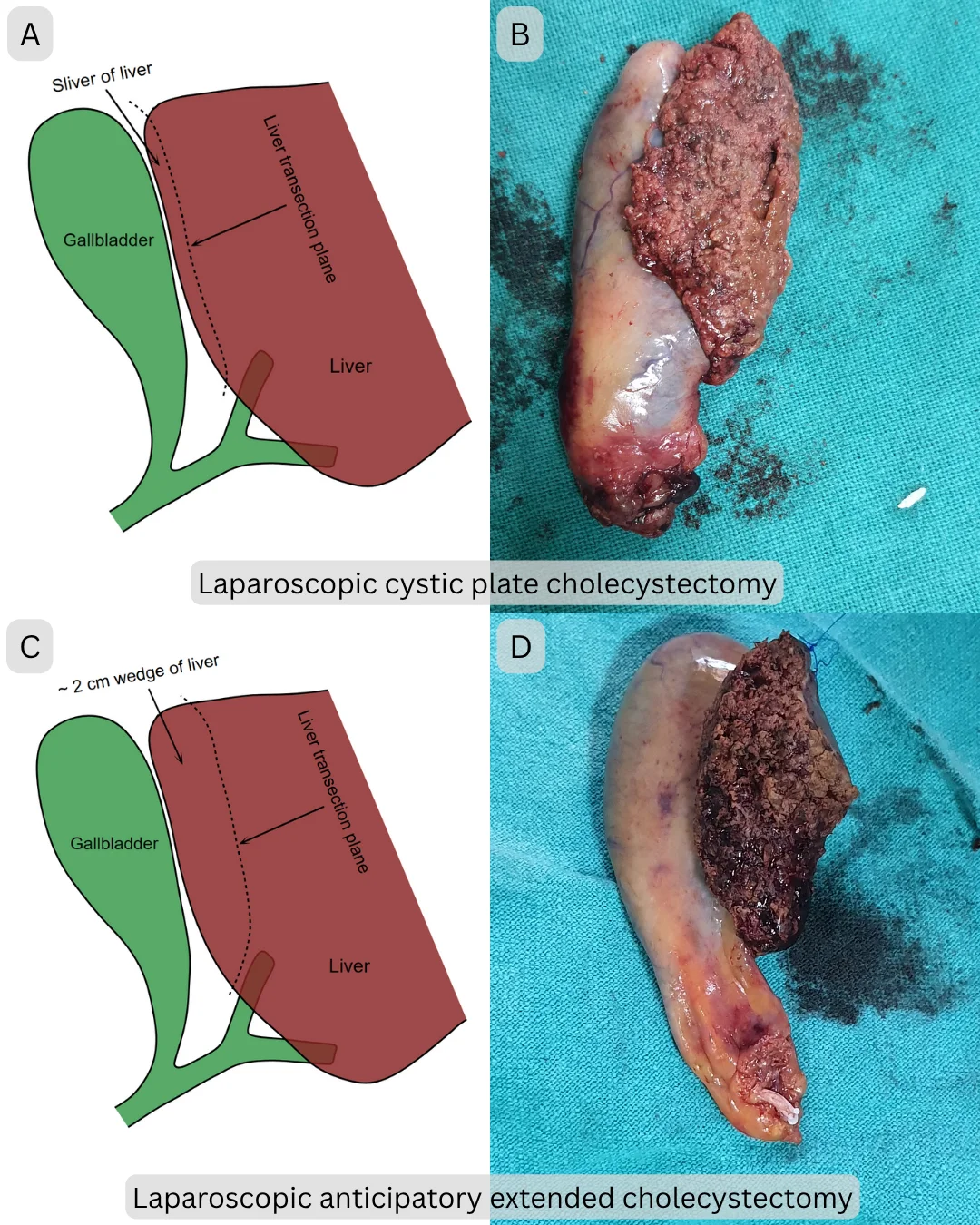 Laparoscopic cystic plate cholecystectomy and laparoscopic anticipatory extended cholecystectomy