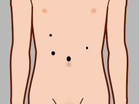 Port placement for laparoscopic distal pancreatectomy
