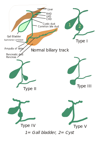 Types of Choledochal Cysts