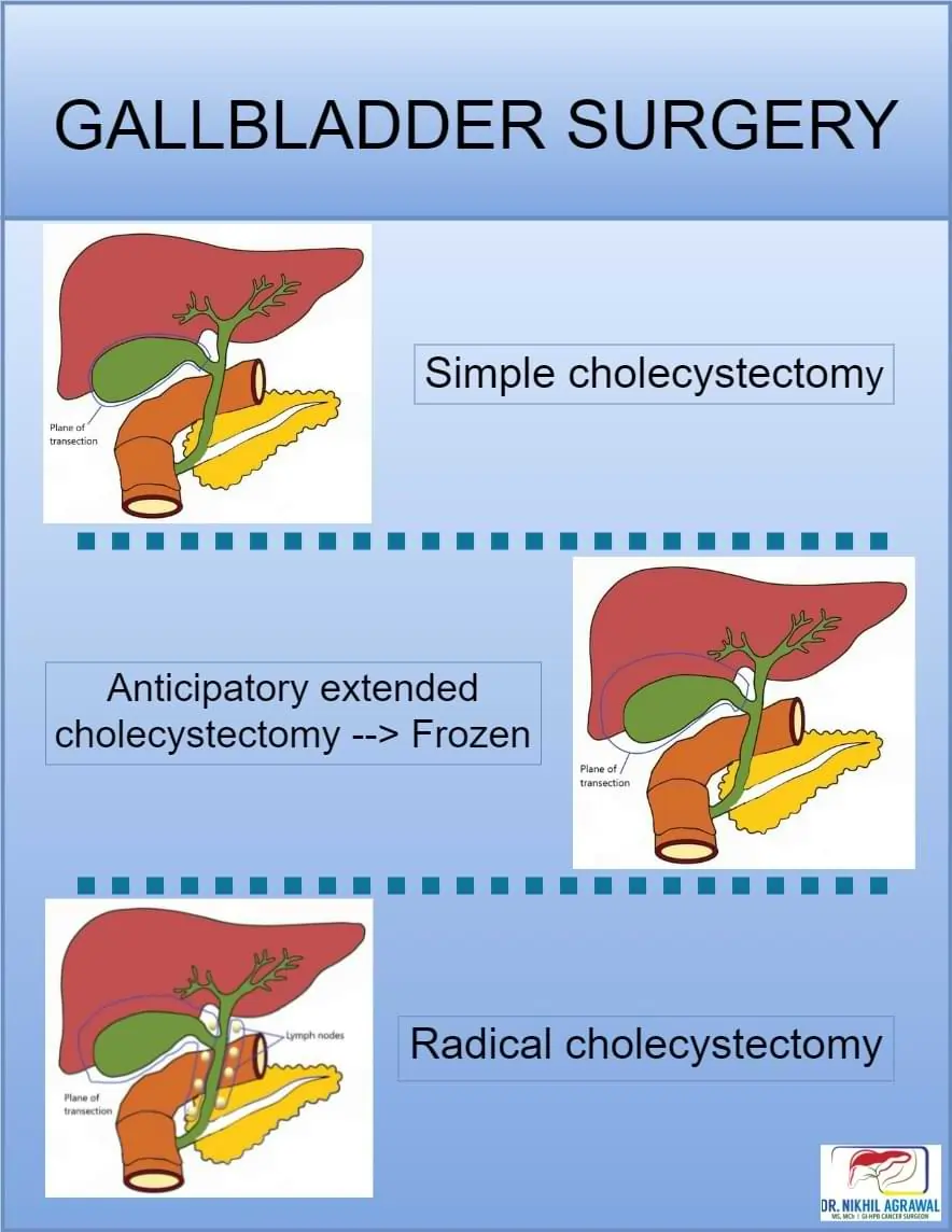 Gallbladder Wall Thickening