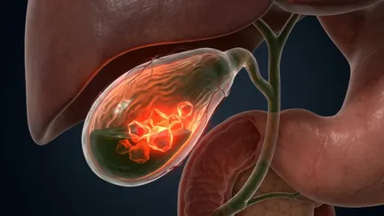 Gallbladder Polyp
