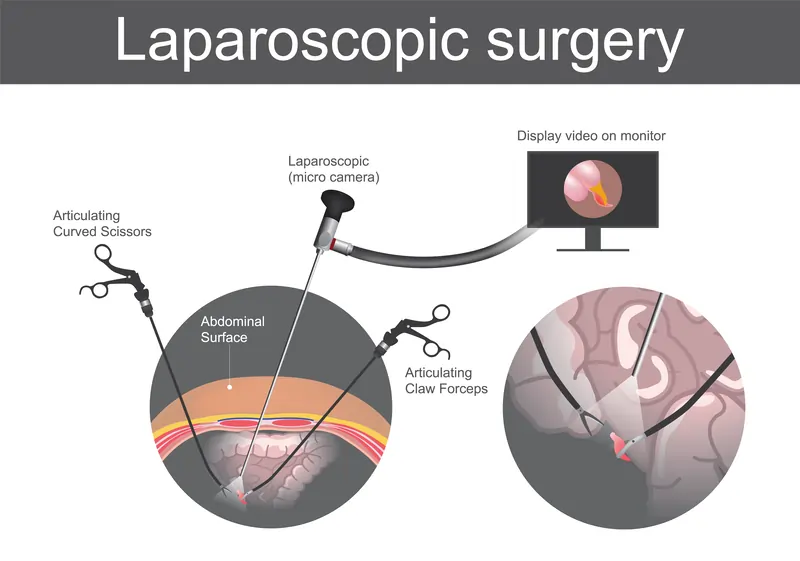 Best Laparoscopic Surgery in Delhi, India