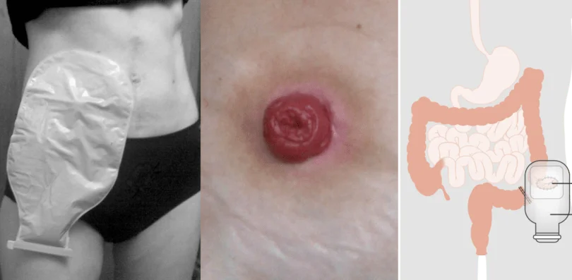 Ostomy Surgery
