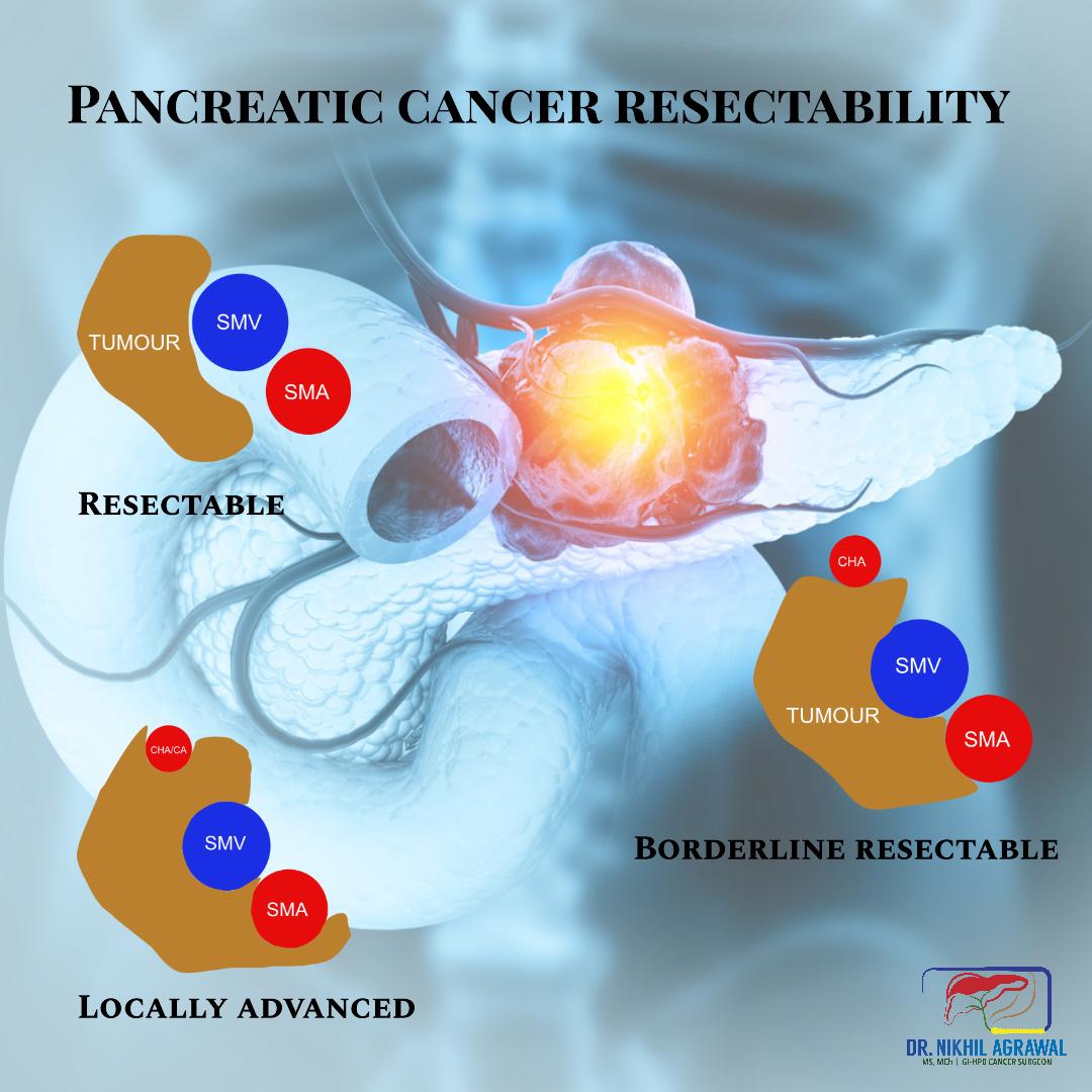 Resectability in pancreatic cancer