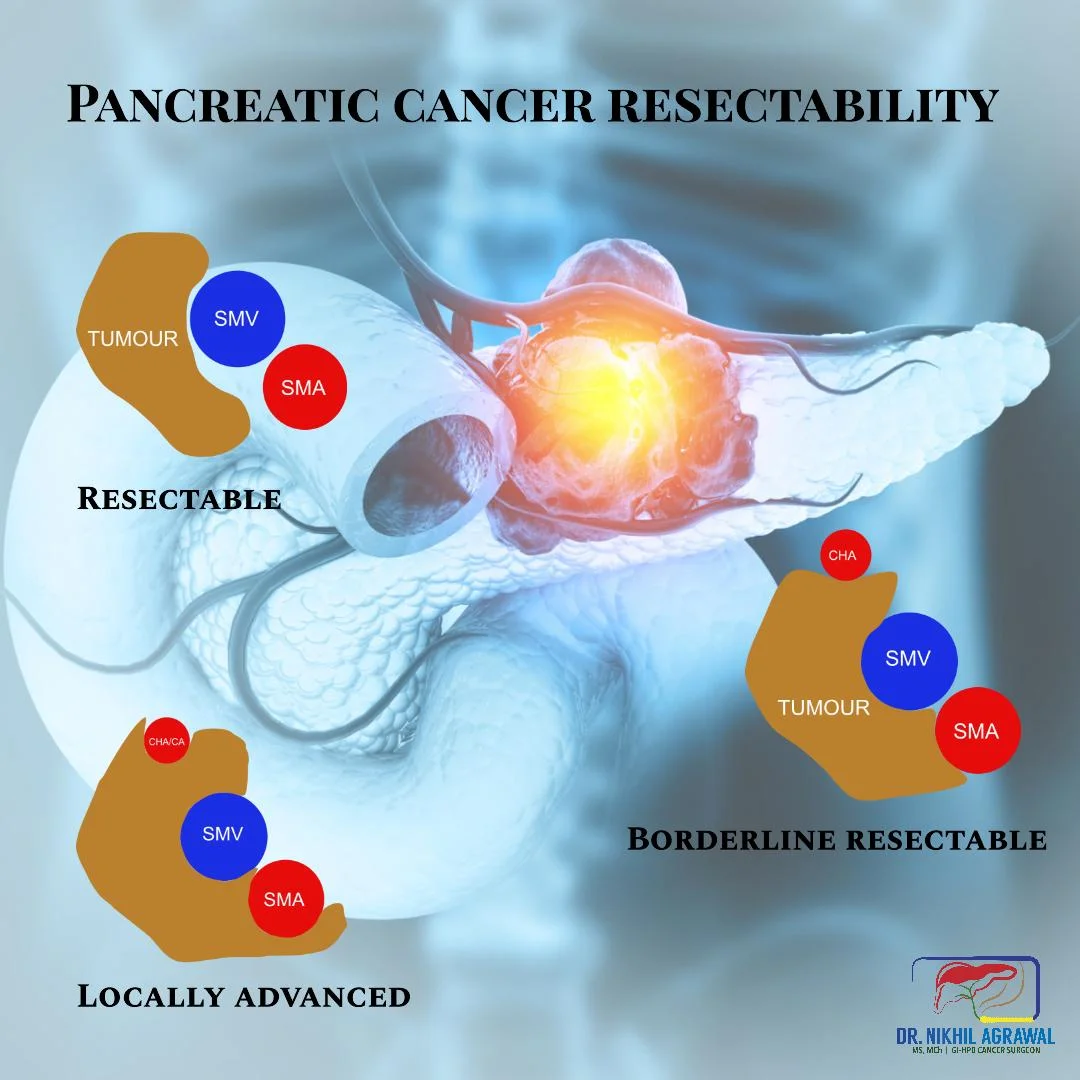 Pancreatic cancer resectability