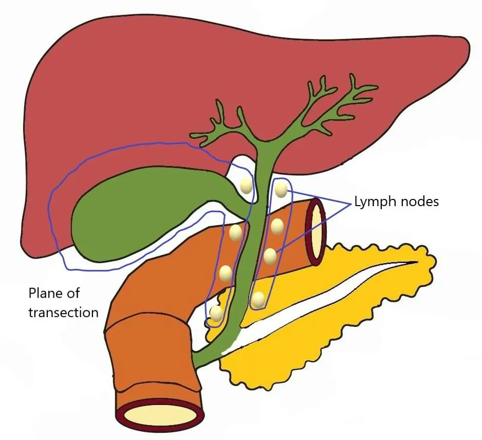 Radical Cholecystectomy