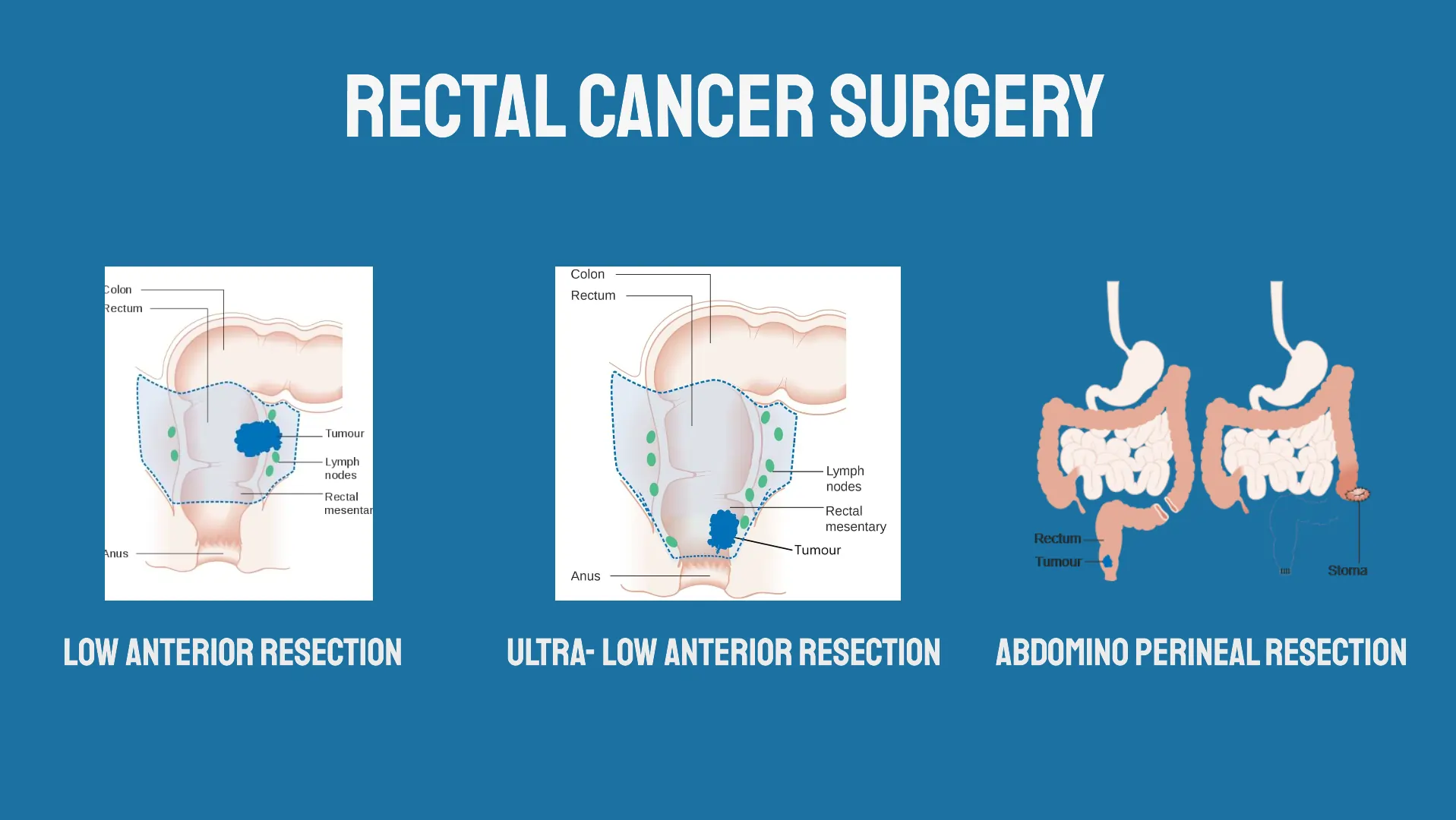 Surgery for rectal cancer