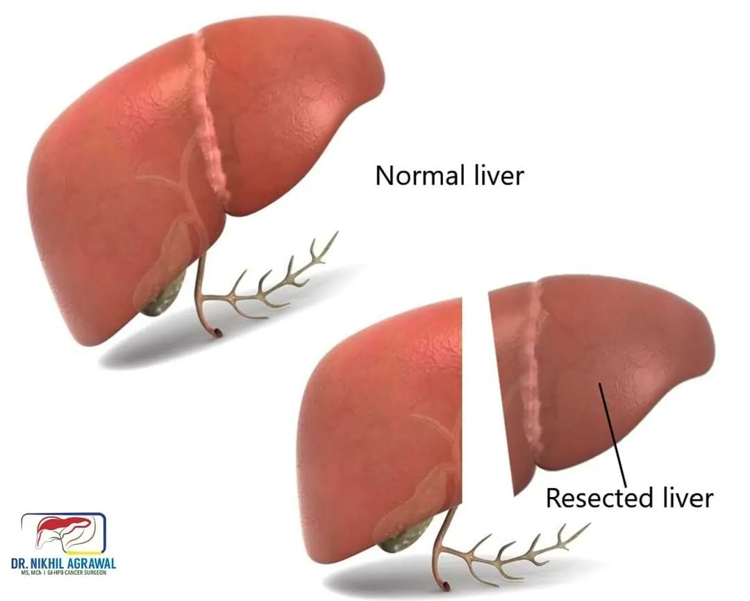 Liver resection